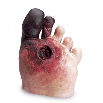 Diabetes Fußpflege erkrankter Fuß mit Wunde in Sohle